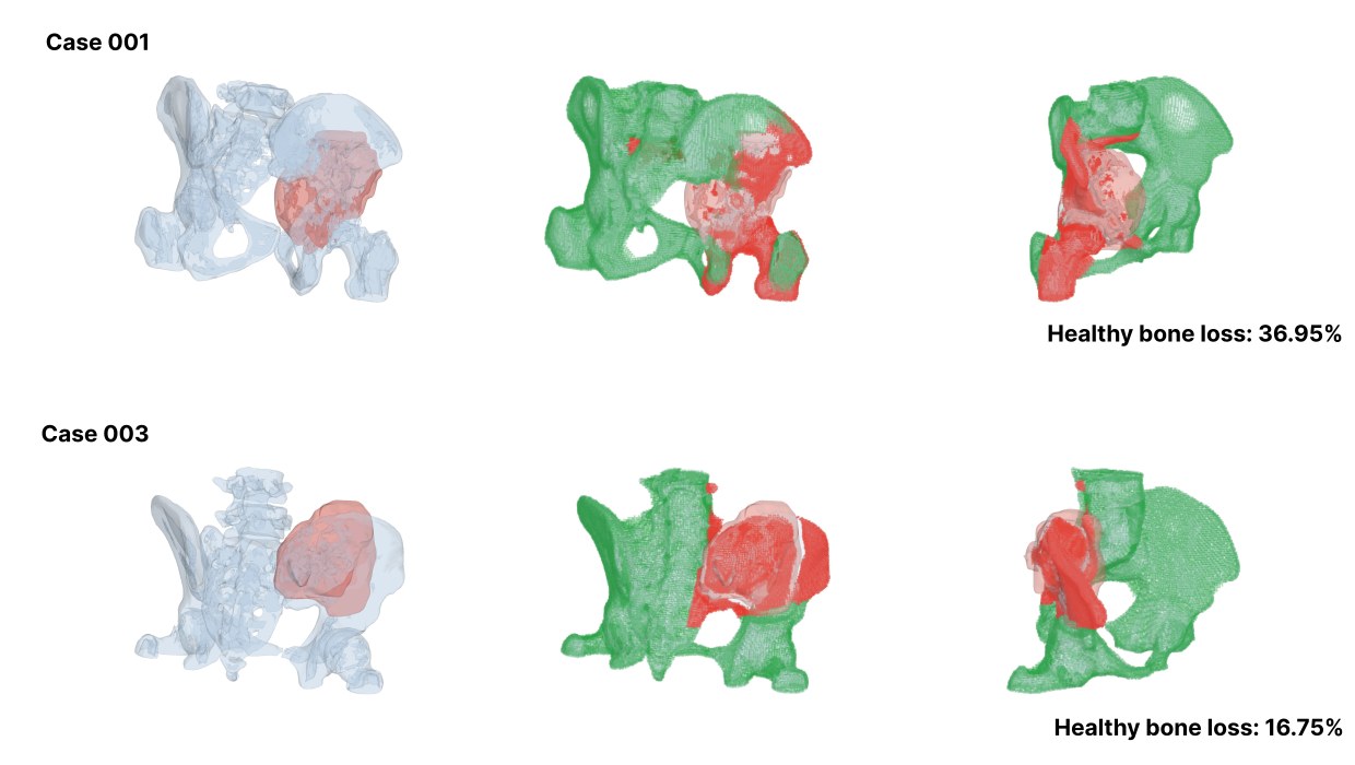 Two cases showing preserved bone in green and healthy bone on the resection side in red, with the healthy-bone-loss percentage.