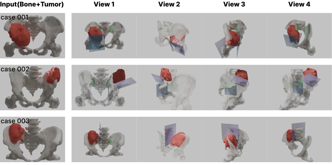 Three clinical pelvic cases: the input pelvis with tumor, and four views of the recommended cutting planes around it.